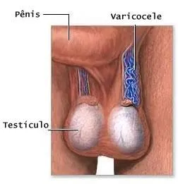 O que é Varicocele