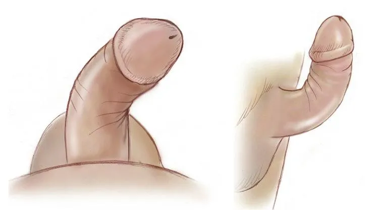 Tratamento Doença de Peyronie