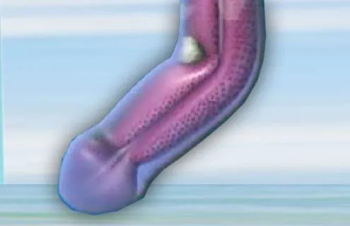 vac-extensor-e-indicado-para-curvatura-peniana