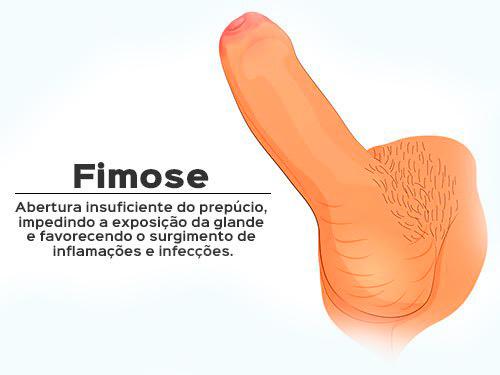 Fimose ilustração
