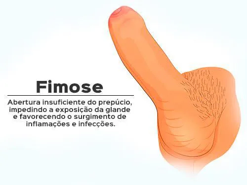 Fimose ilustração