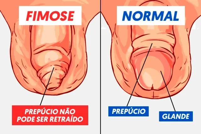 O que é Fimose