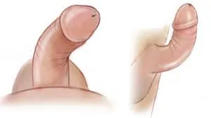 Doença de Peyronie