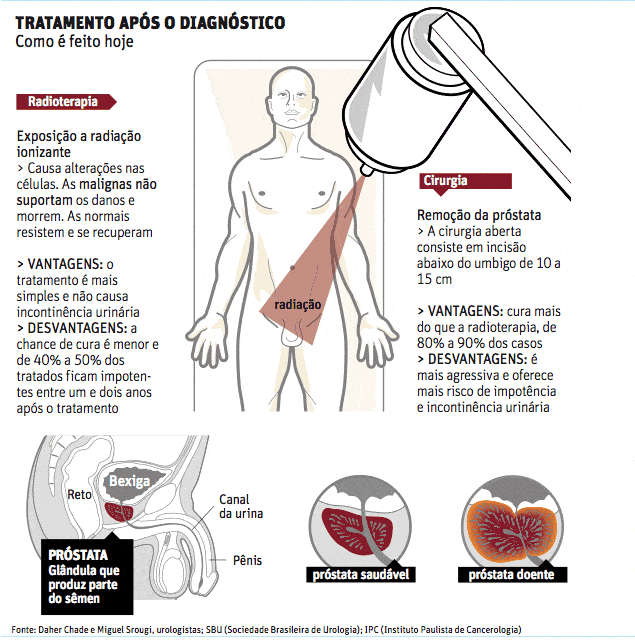 Tratamento câncer de próstata