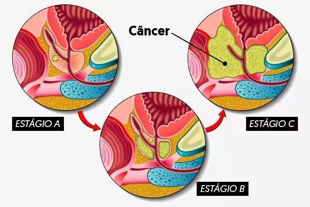 câncer de próstata estágios