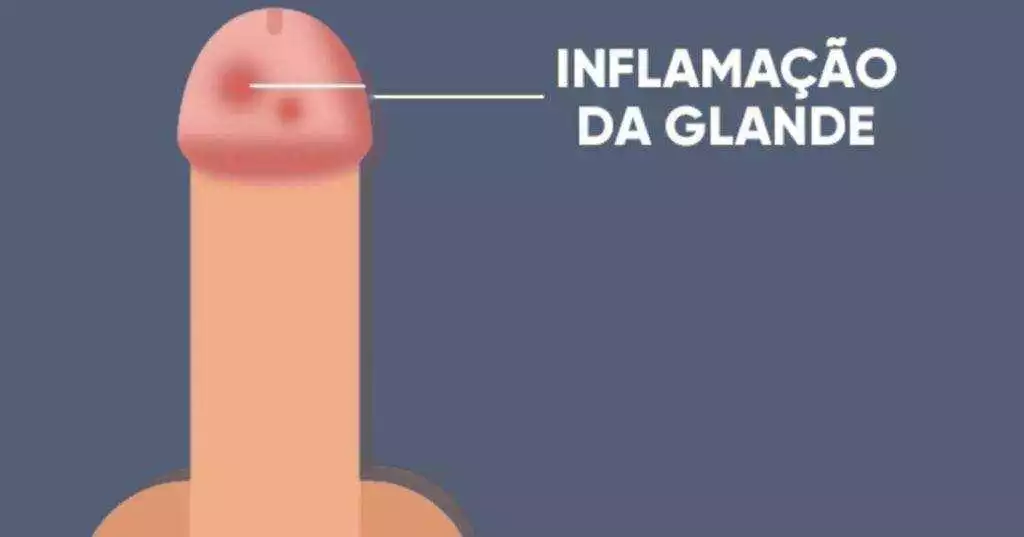 O que é a Balanite? Causas, Sintomas e Tratamento