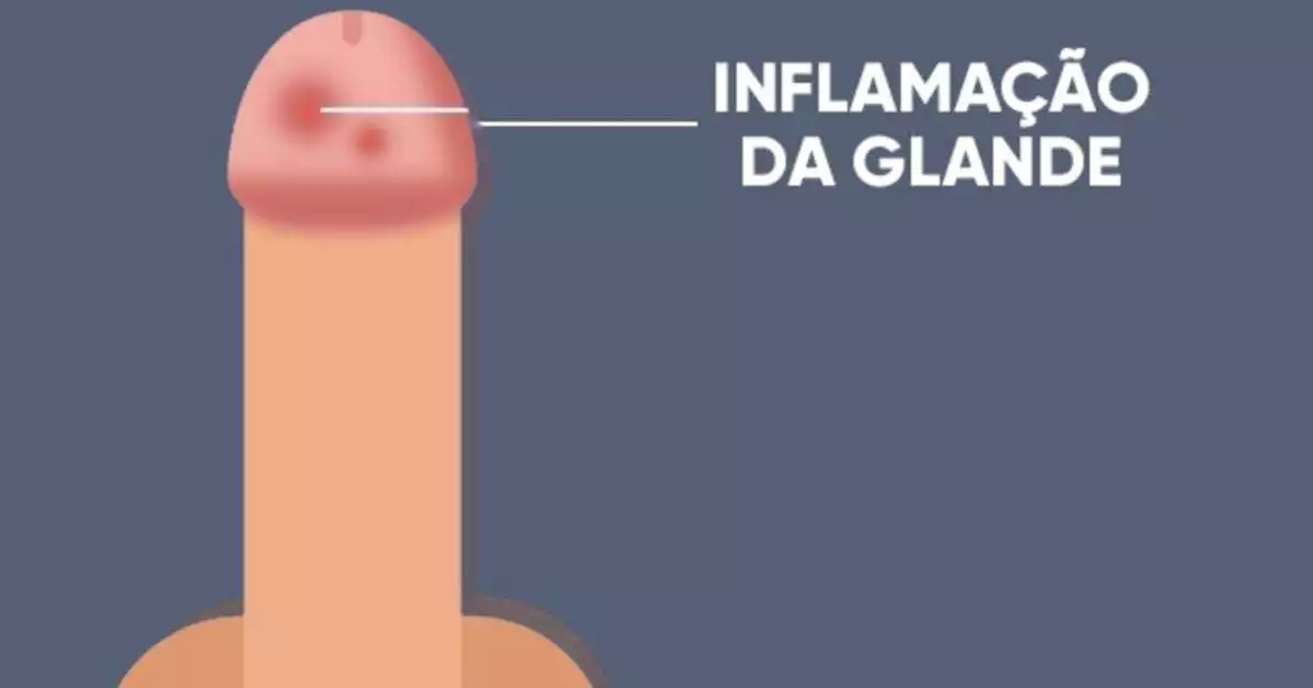 O que é a Balanite? Causas, Sintomas e Tratamento O que é a Balanite? Causas, Sintomas e Tratamento
